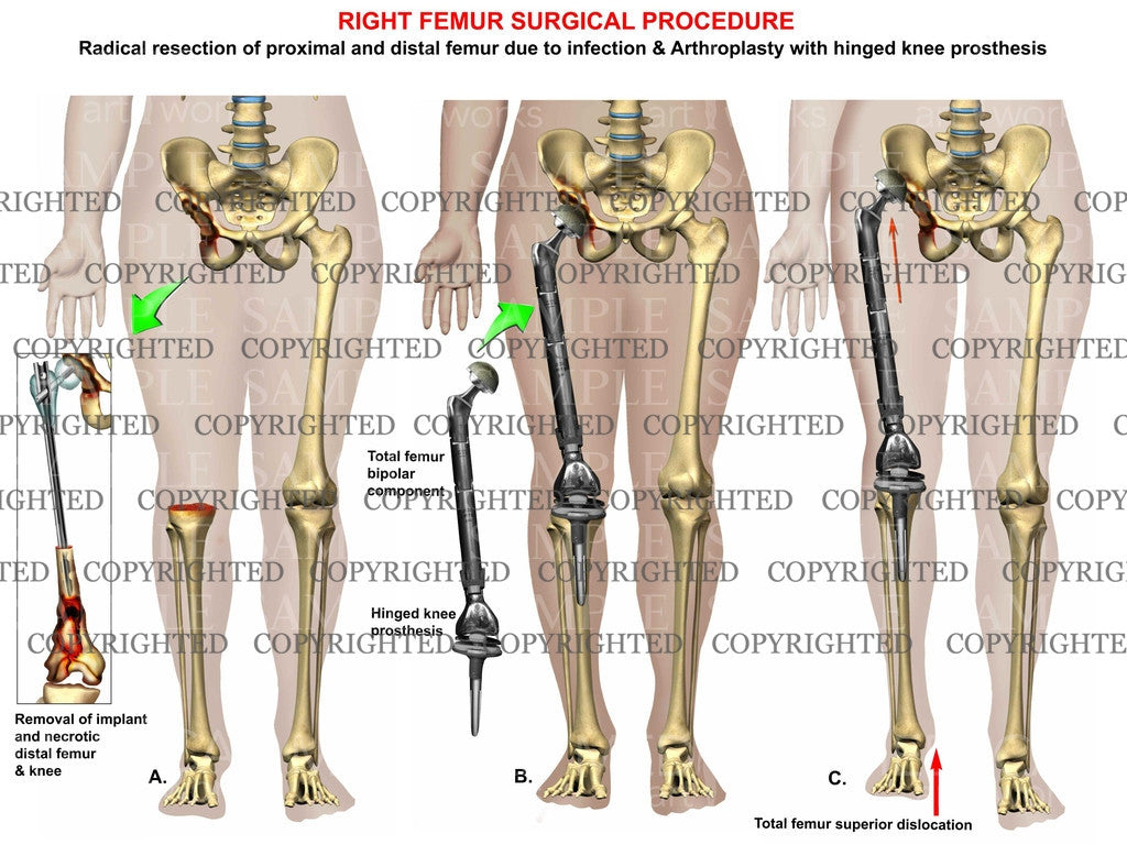 Femur radical resection