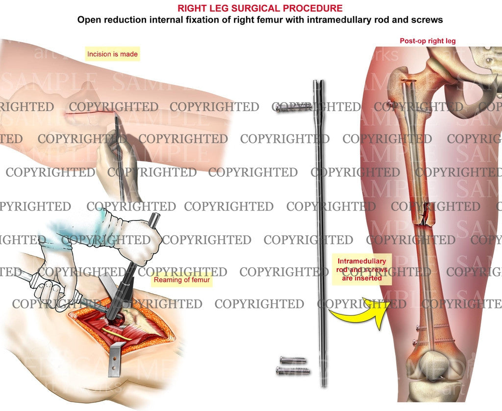 Right leg surgery