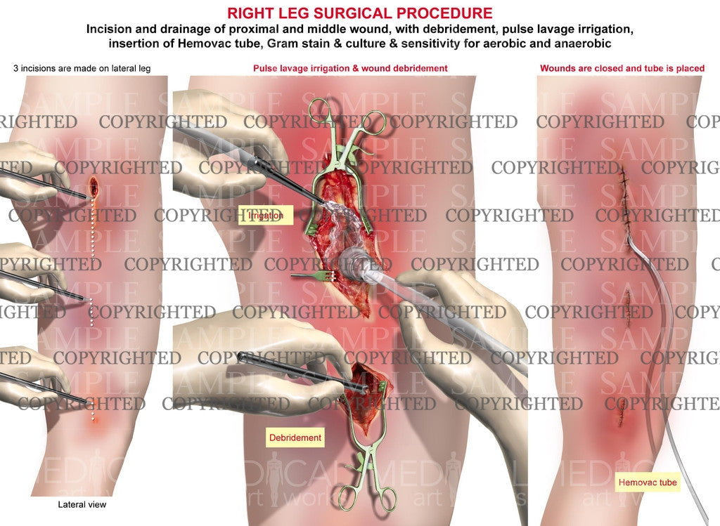 Right leg surgical procedure