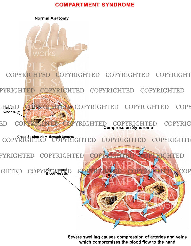 Forearm compartment syndrome