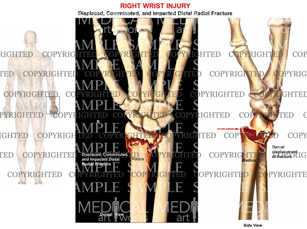 Right radius fracture displacement