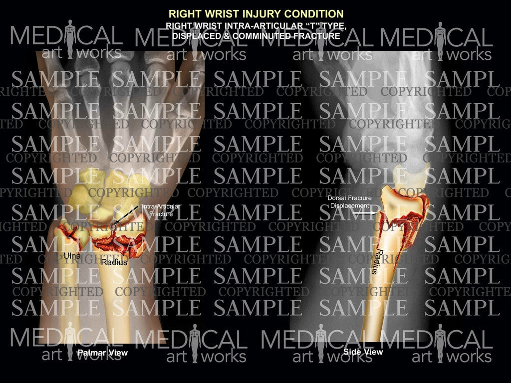 Right wrist intra-articular "T" Type fracture