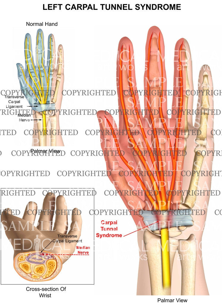Left carpal tunnel syndrome