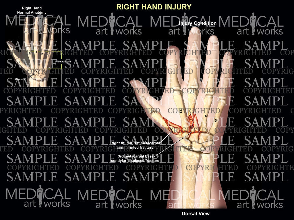 Right metacarpal fractures