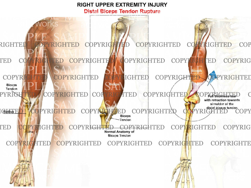 Right biceps tendon tear