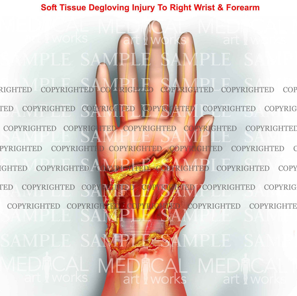 Right hand degloving injury