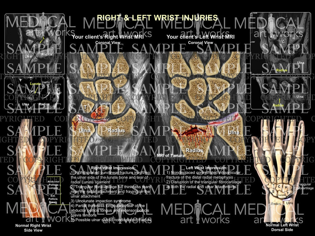 Wrists bilateral fractures