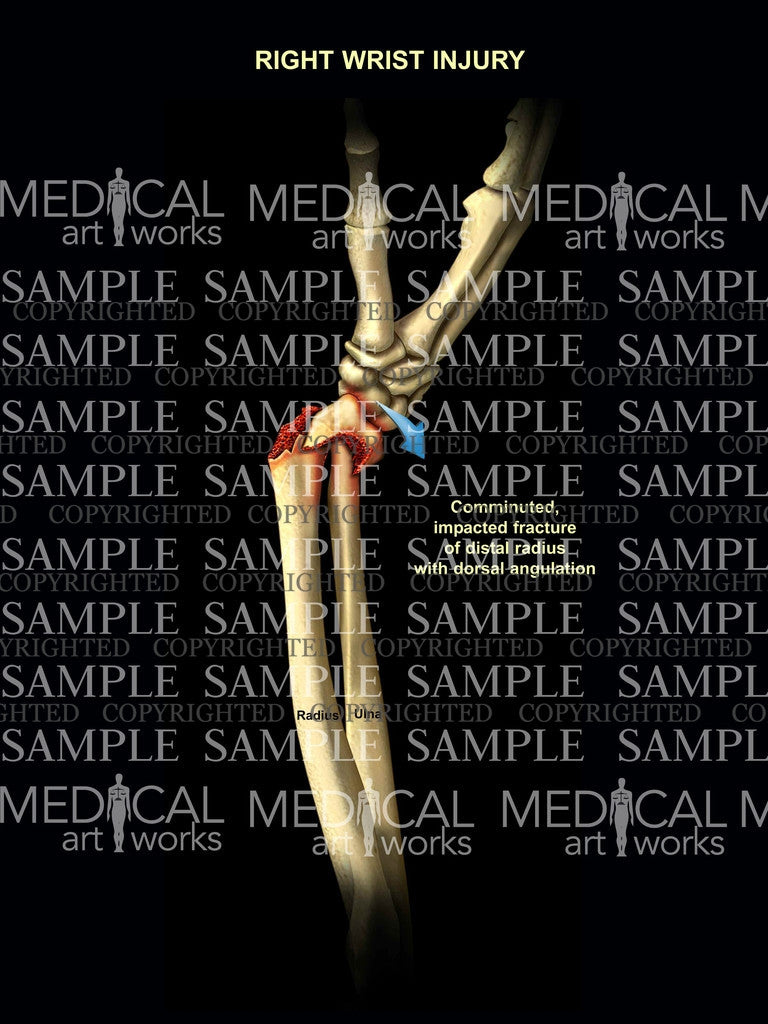 Right radius impacted fracture