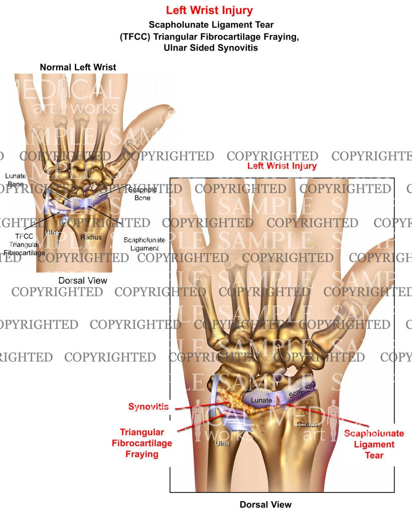 Left scapholunate lig tear + TFCC