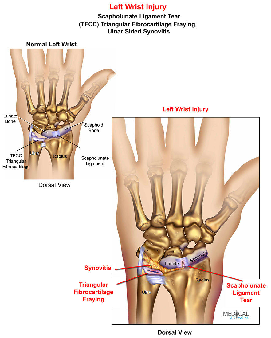 Left scapholunate lig tear + TFCC