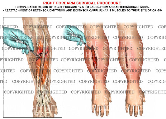 Right forearm extensor reattachment