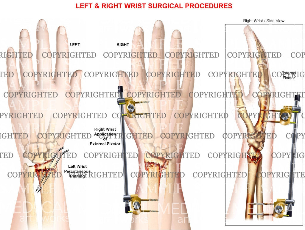 Wrist fracture pinning