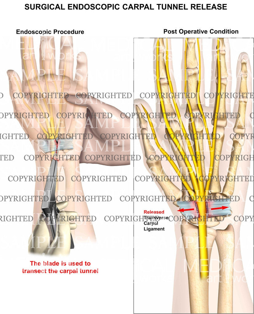 Endoscopic carpal tunnel release