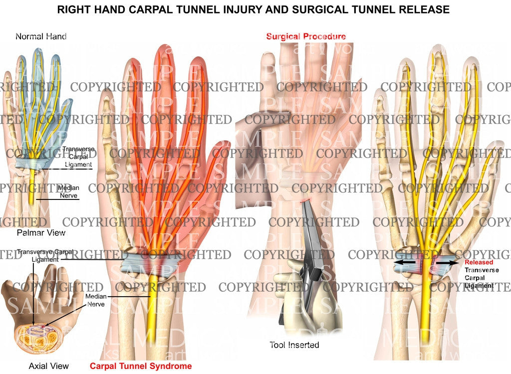 Right carpal tunnel release