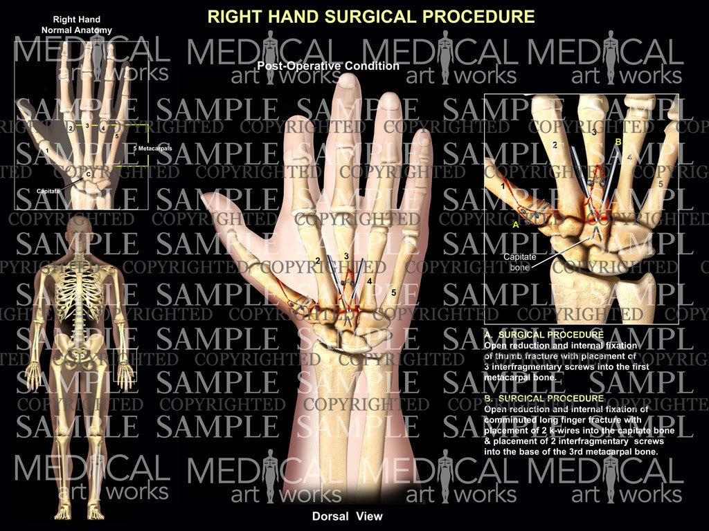 Right metacarpal pinning - ORIF