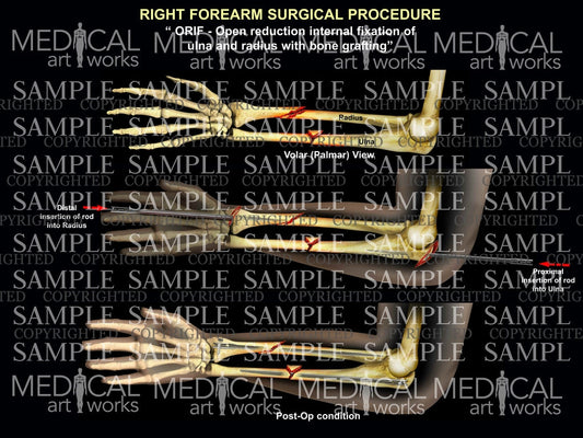 Right forearm radial ulna rodding