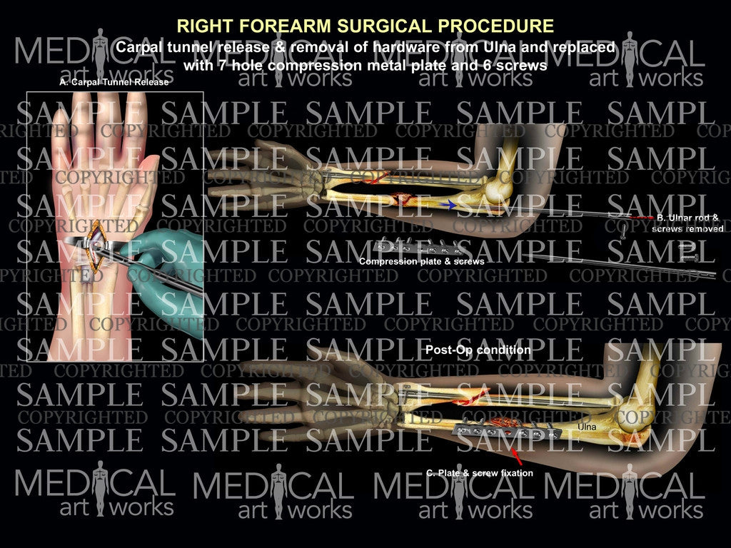 Right ulna compression plate