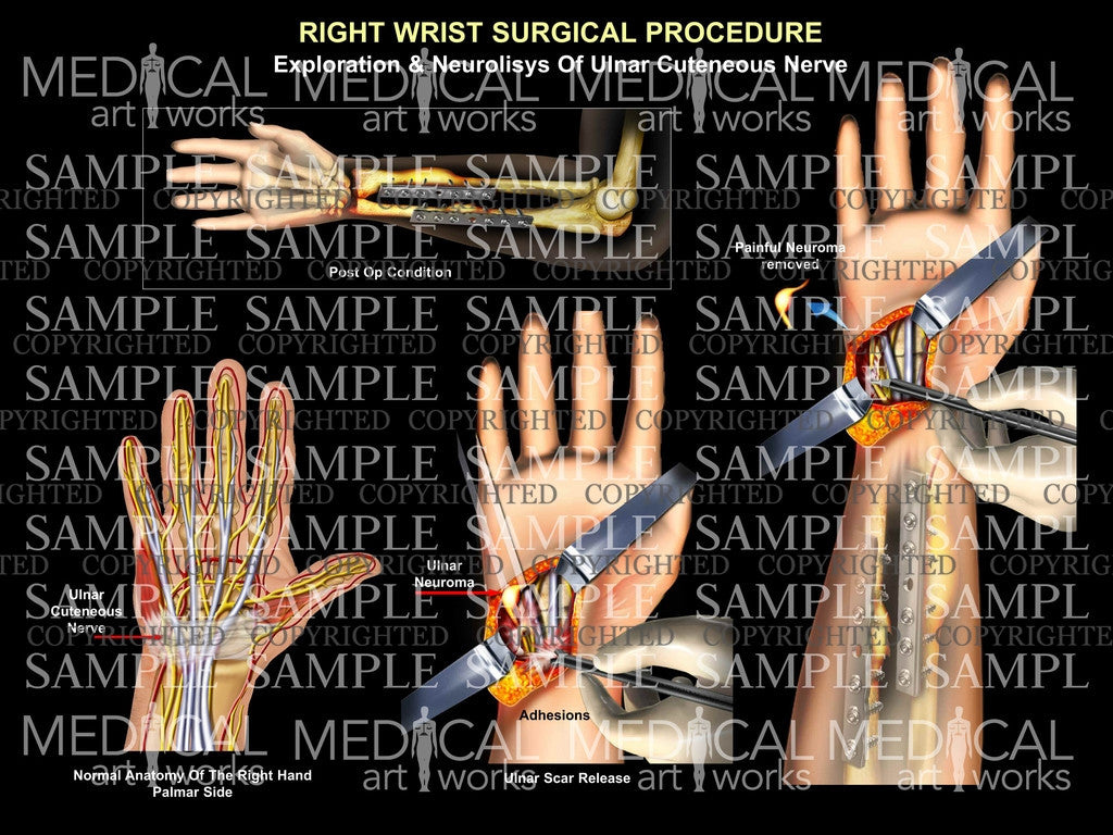 Right ulnar neurolysis