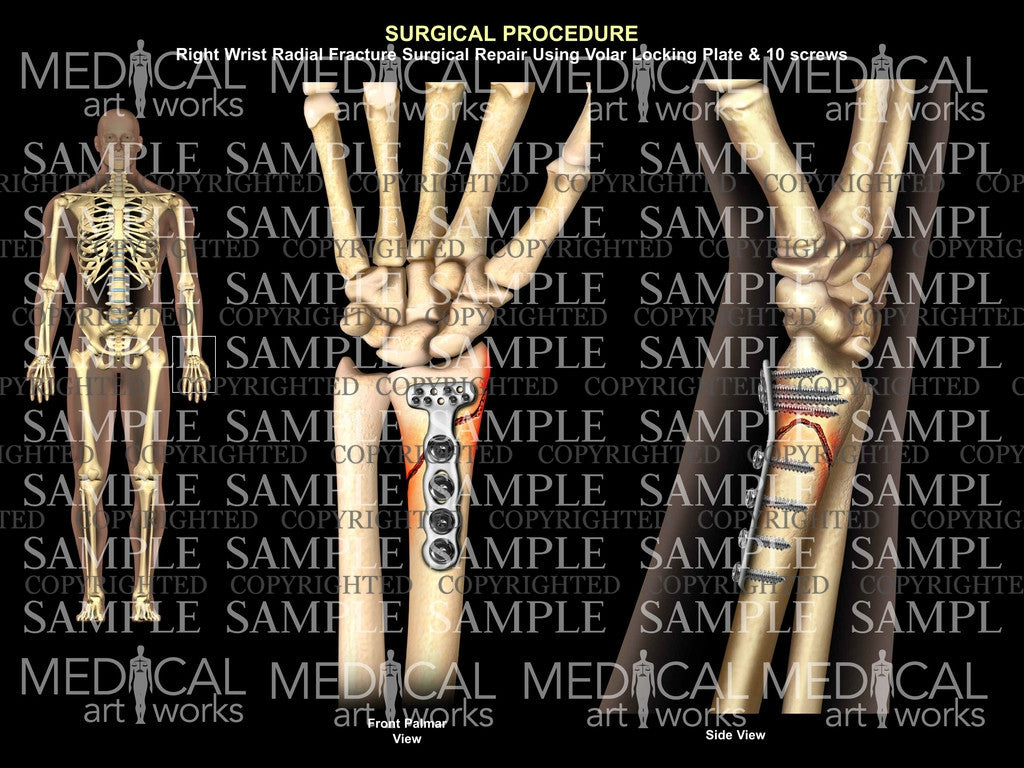 Right radial fracture+plate ORIF