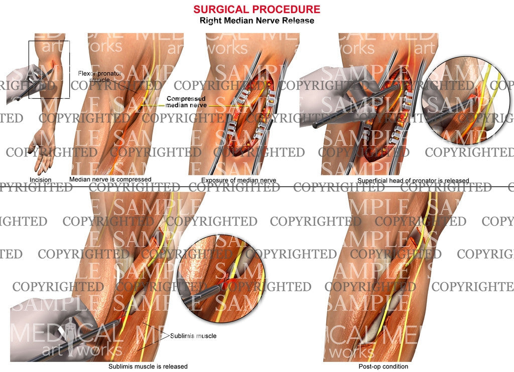 Right median nerve release