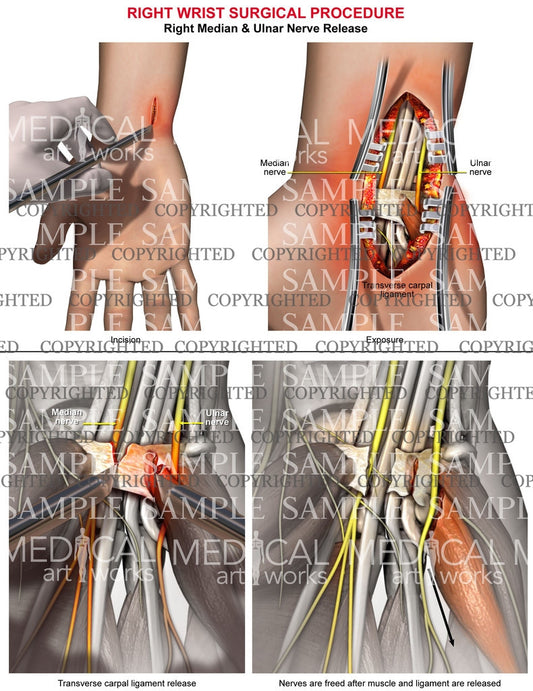 Right median and ulnar nerve release