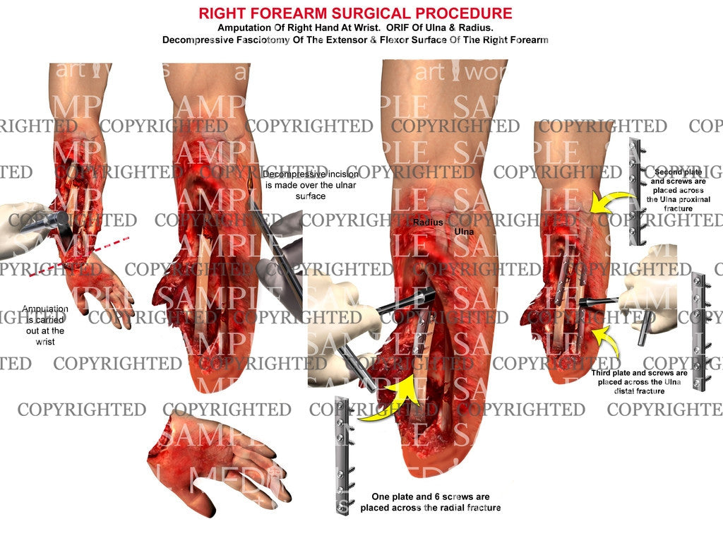 Right hand amputation - ORIF