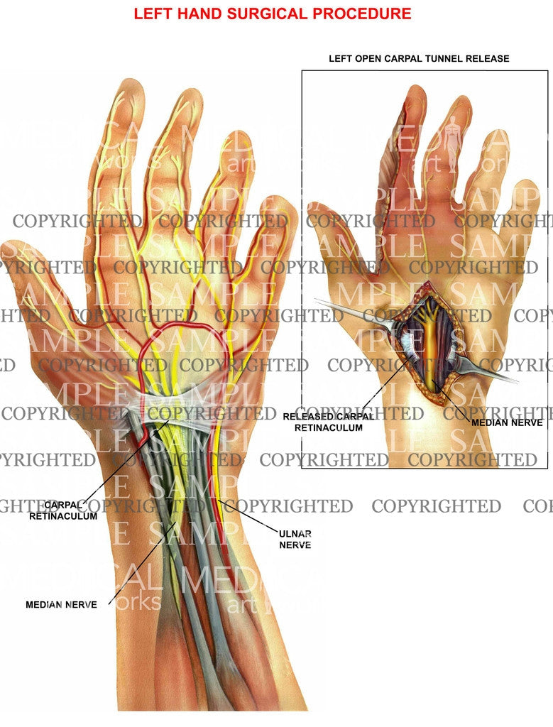 Left hand carpal tunnel procedure