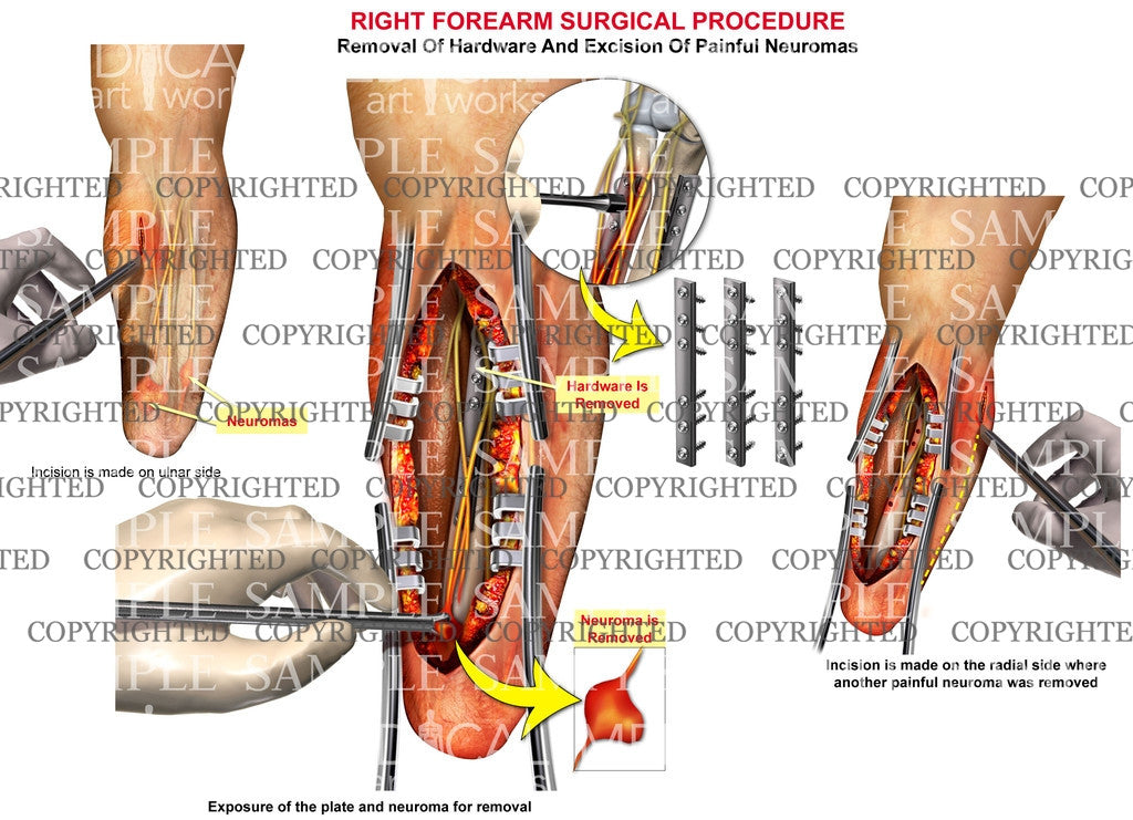 Right amputed hand - neuromas