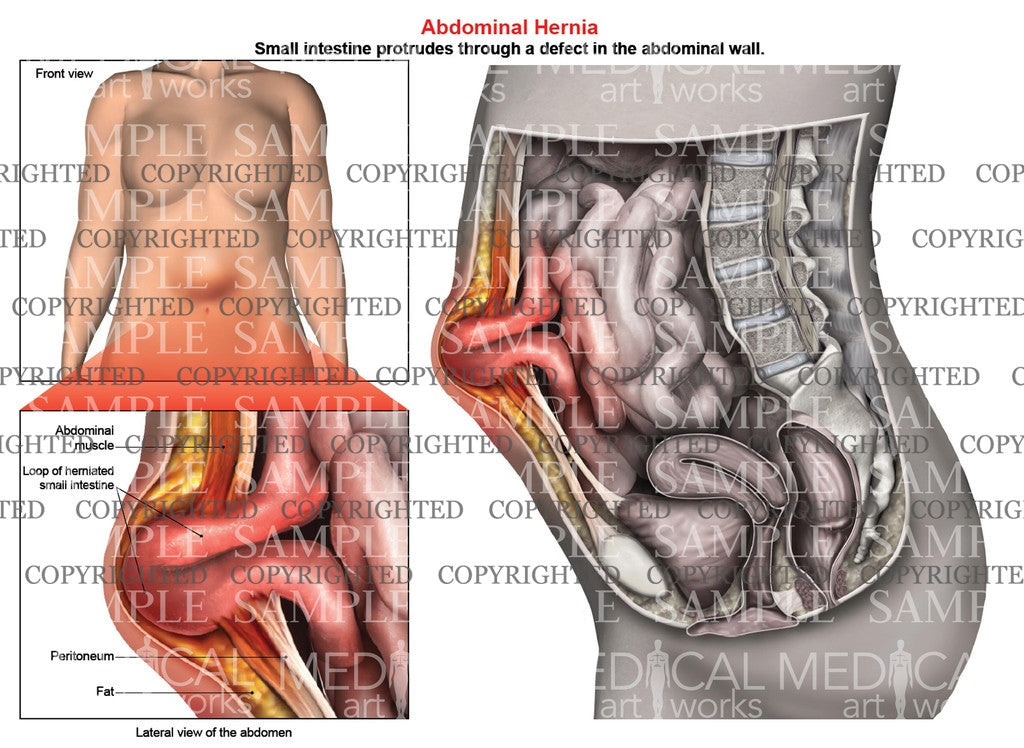 Abdominal hernia anatomy of female