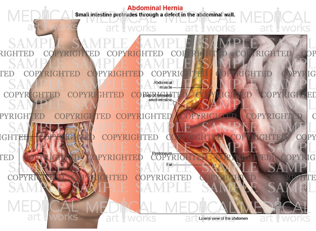 Abdominal hernia anatomy of female, lateral view