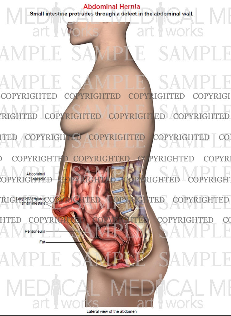 Abdominal hernia anatomy of female, lateral single view