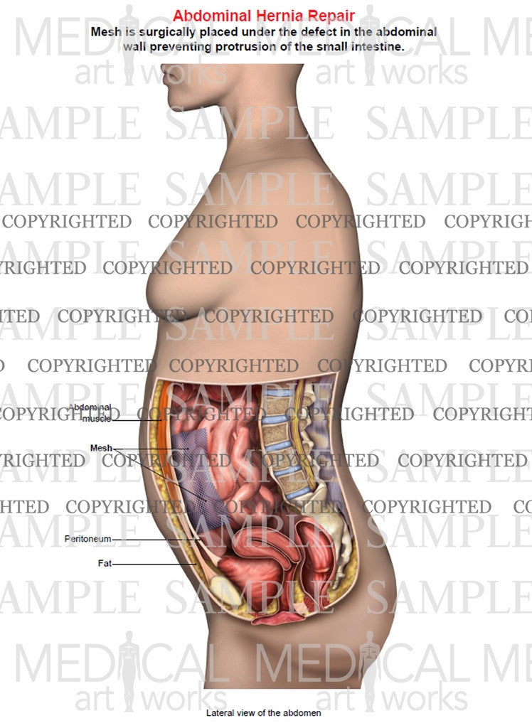 Abdominal hernia mesh repair of a female, single image