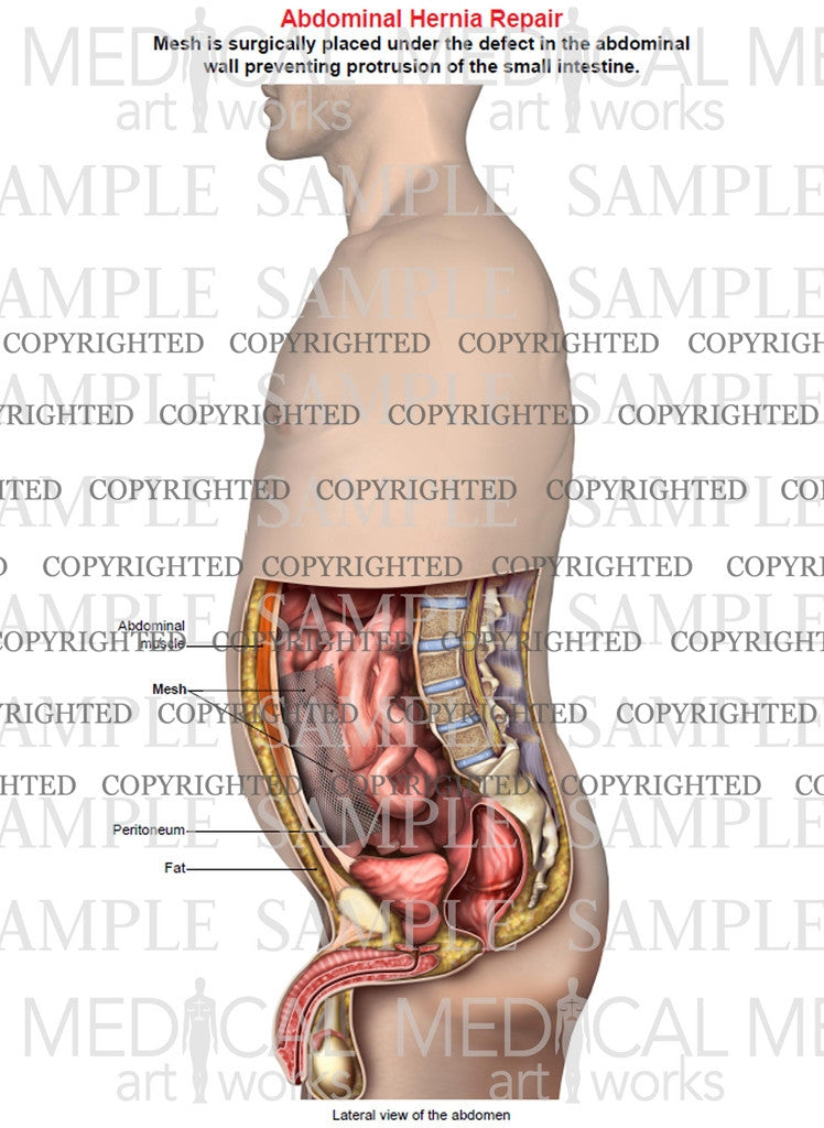 Abdominal hernia mesh repair of a male, single image