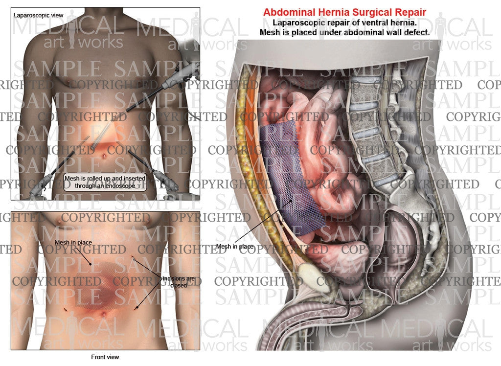 Abdominal ventral hernia mesh repair of a male