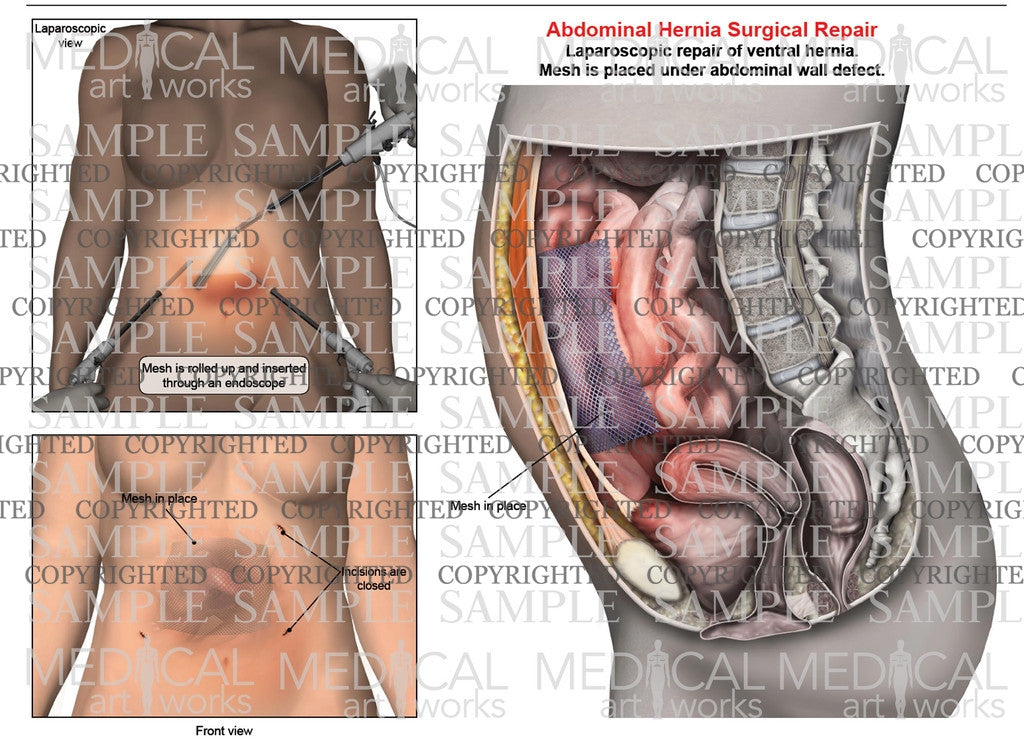 Abdominal ventral hernia mesh repair of a female