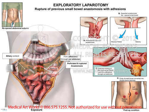 Exploratory Laparotomy