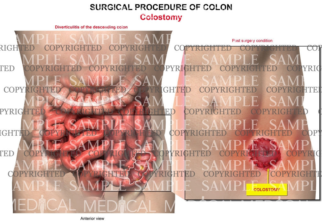 Descending colon surgery