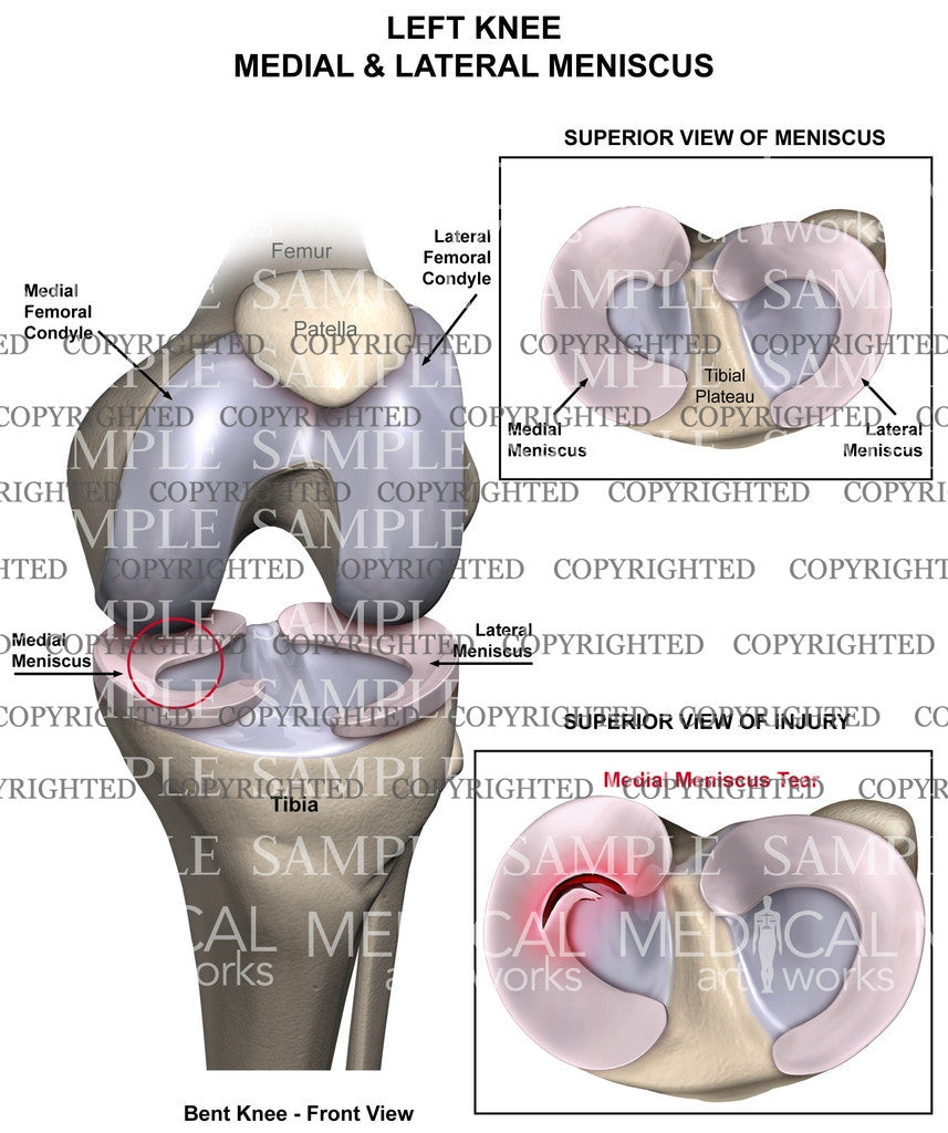 Left Knee medial meniscus tear