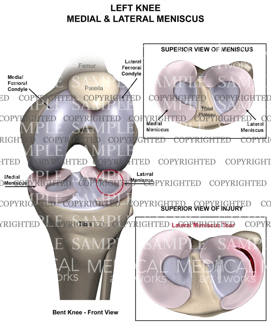 Left Knee lateral meniscus tear