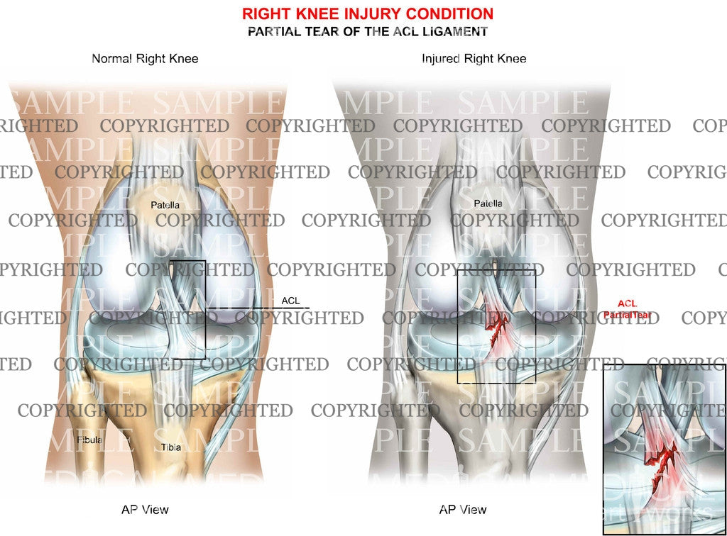 Right knee tear