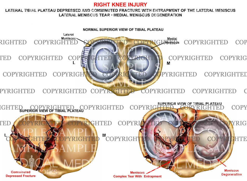 Right knee tibial fracture - superior view