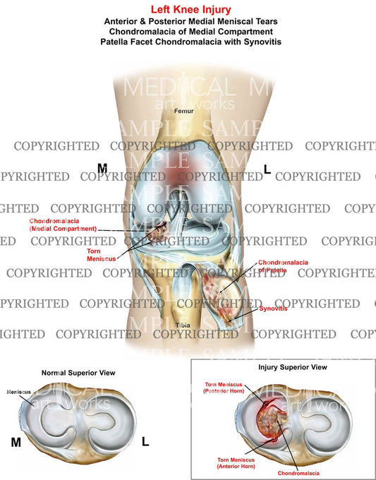 Left Knee Injury anterior and posterior medial mensicus tear - chondromalacia