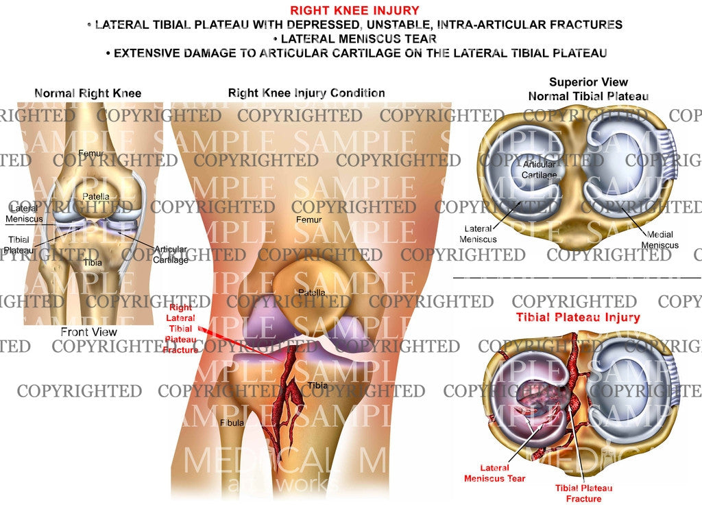 Right knee traumatic injury of tibia