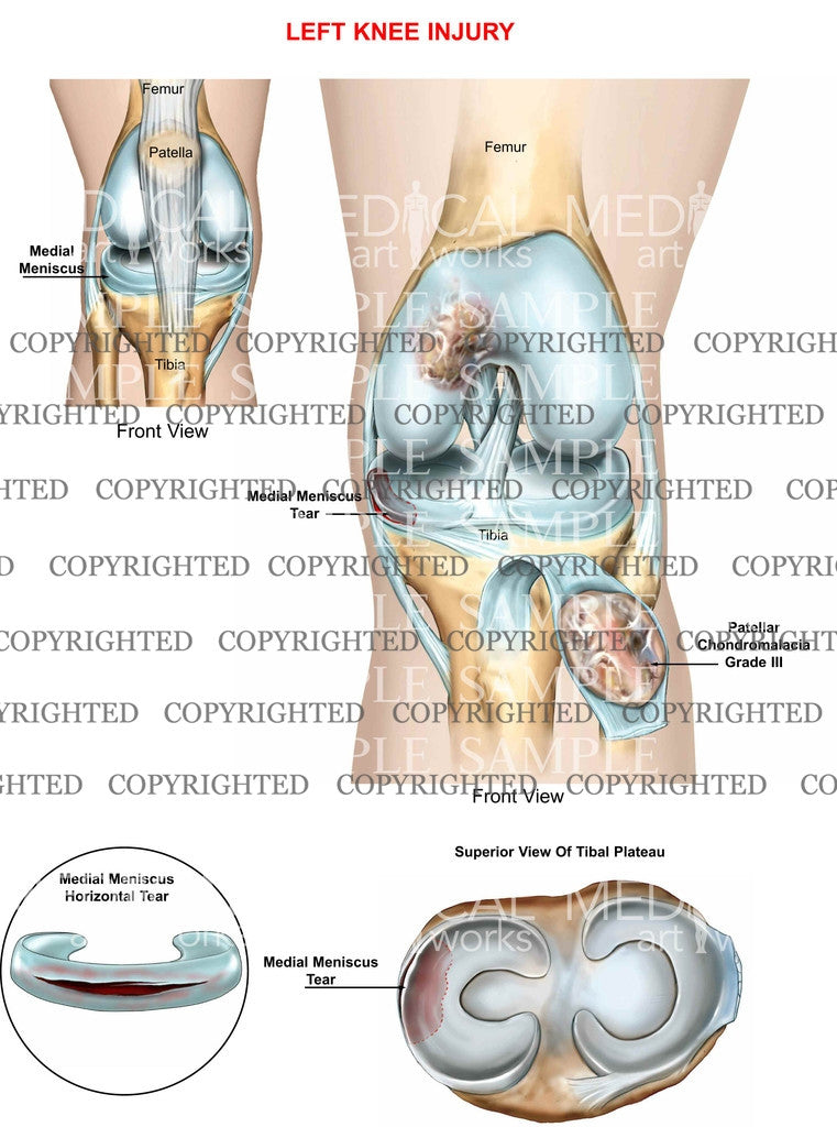 Left Knee Medial Meniscus Horizontal Tear