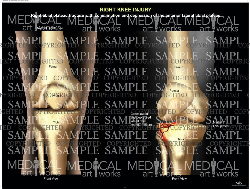 Right tibial plateau fracture with comminution and depression