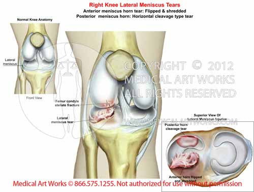 Right Knee Lateral Meniscus Tears