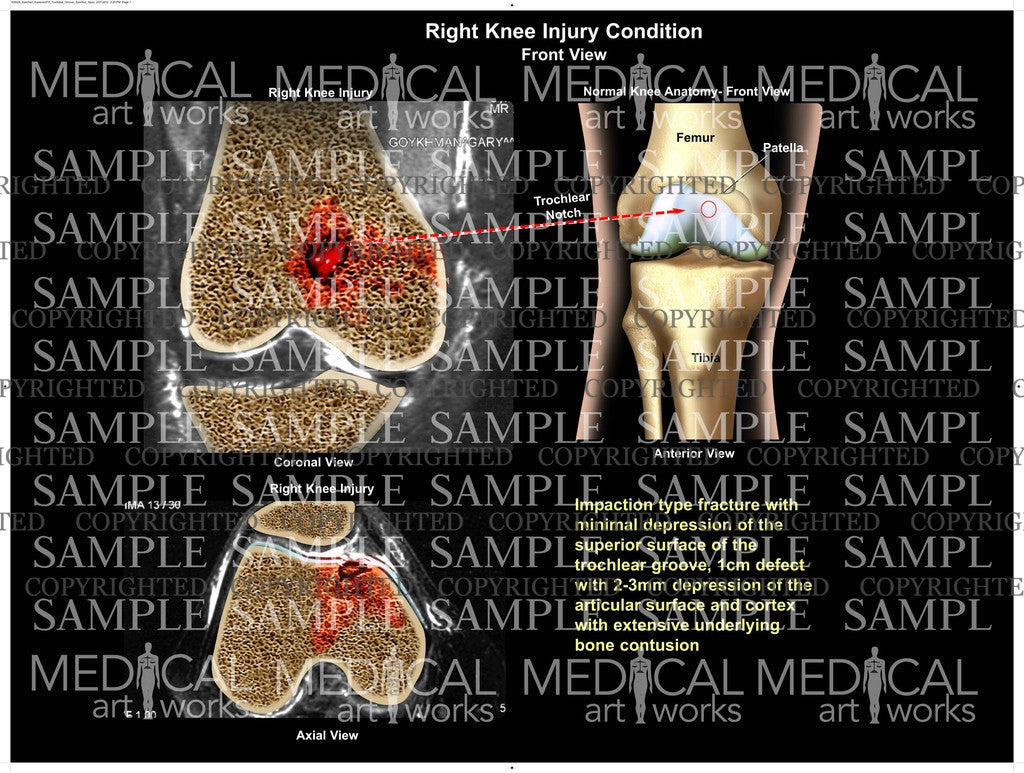 Right Knee impaction fracture