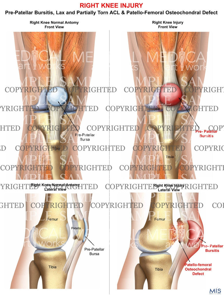 Right Knee Injury Pre-Patellar Bursitis and Patellofemoral Osteochondral Defect