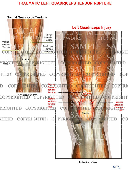 Traumatic Left Quadriceps Tendon Rupture