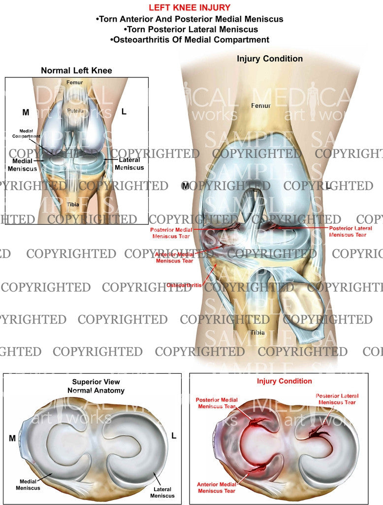 Left Knee Injury condition with tears